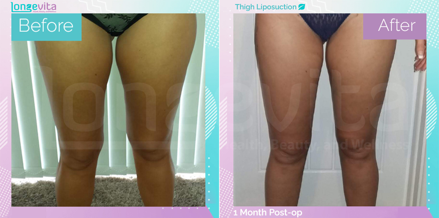 Liposuction before and after, Body
