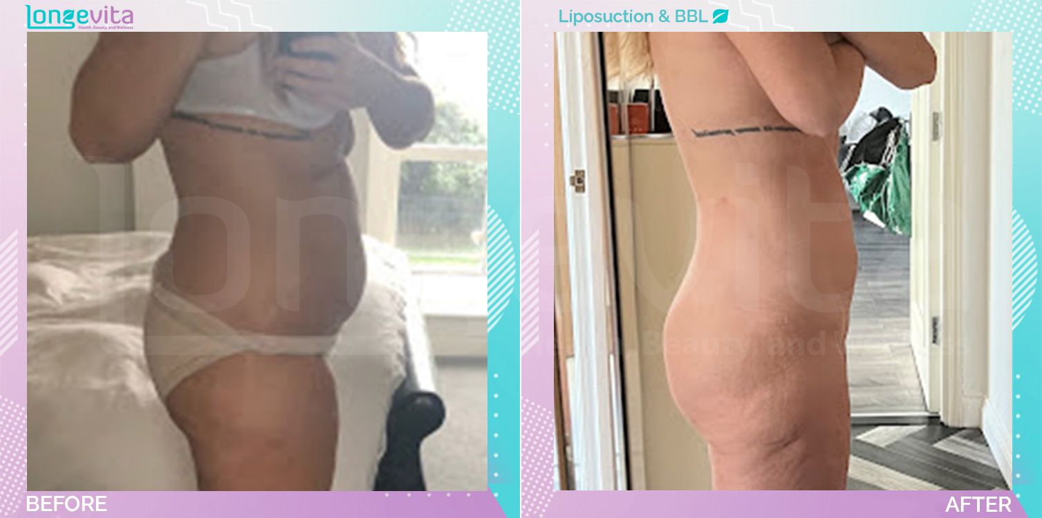 Bum Lift and Liposuction before and after, Body, 30s female patient