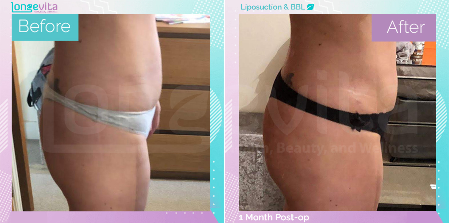 Bum Lift and Liposuction before and after, Body