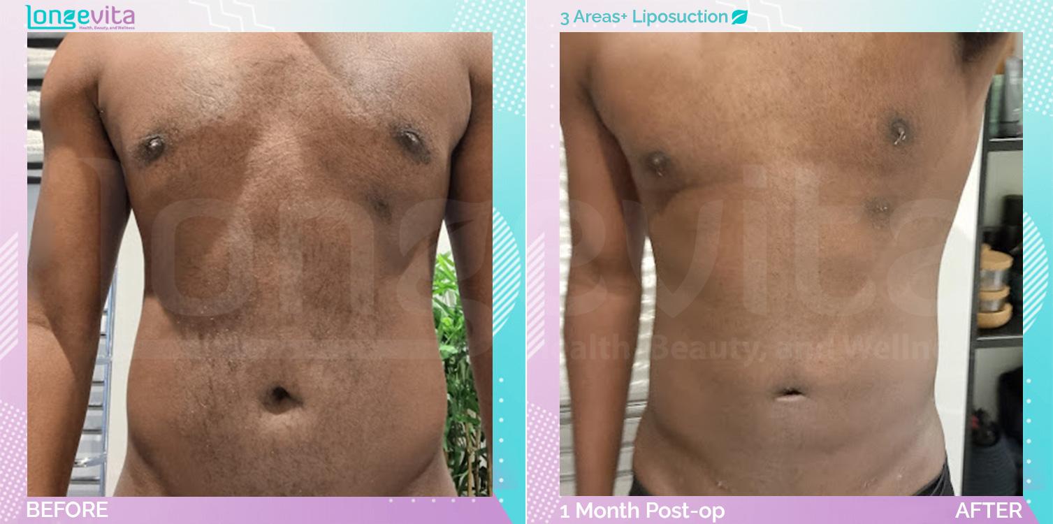 Liposuction before and after, Body, 30s male patient