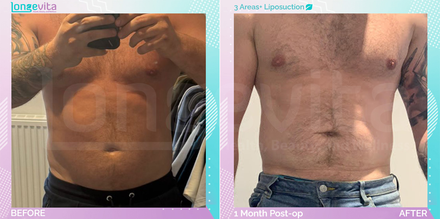 Liposuction before and after, Body, 30s male patient