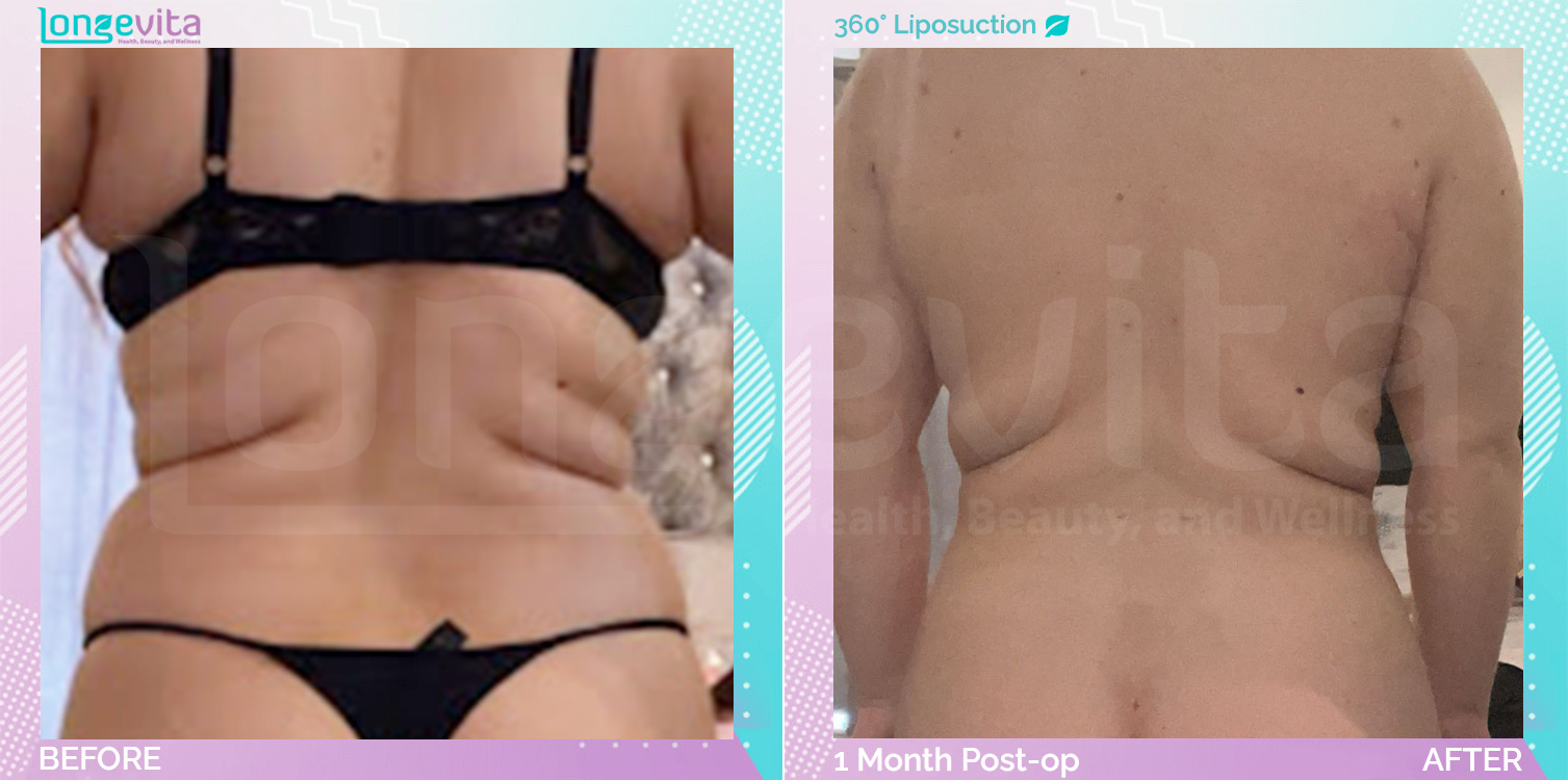 Liposuction before and after, Body, 20s female patient