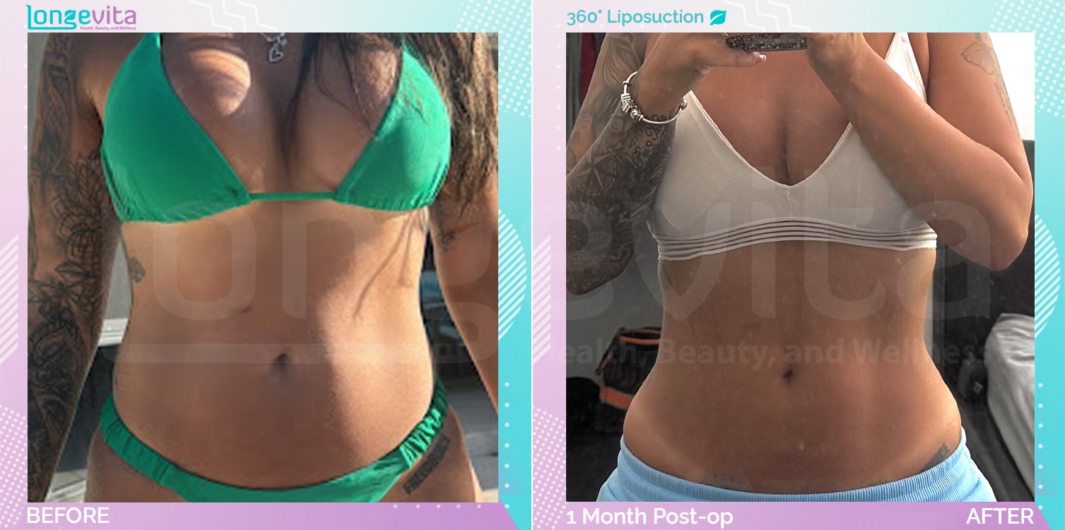Liposuction before and after, Body, 30s female patient