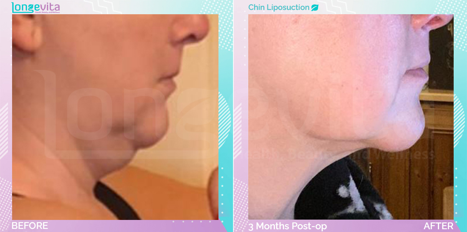 Liposuction before and after, Face, 50s female patient
