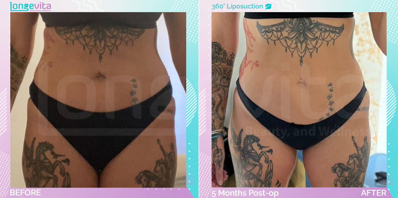 Liposuction before and after, Body, 40s female patient