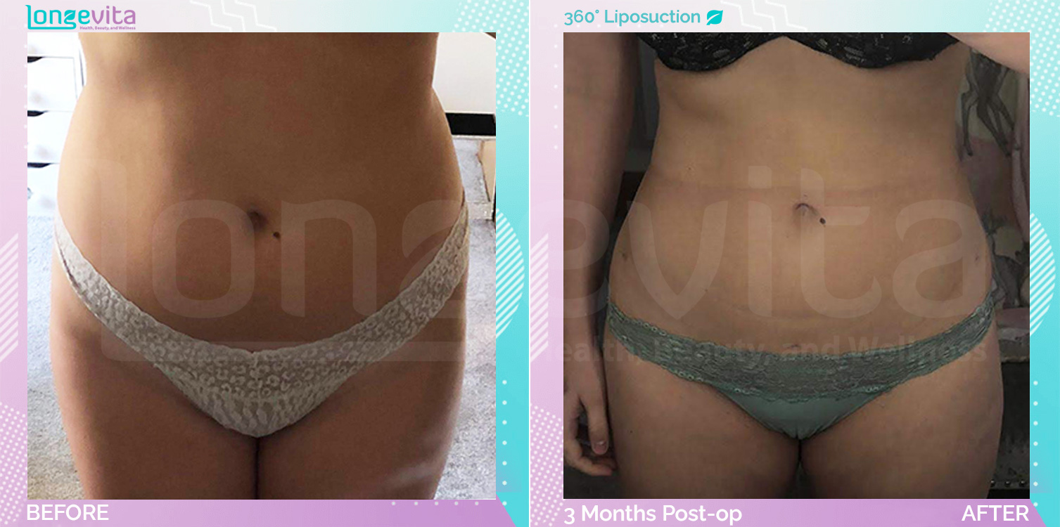 Liposuction before and after, Body
