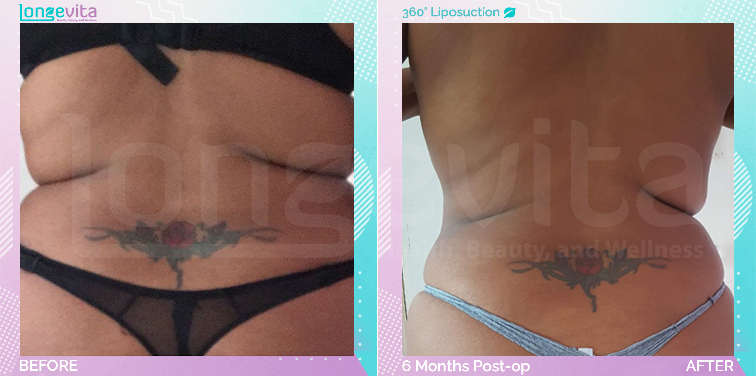 Liposuction before and after, Body, 40s female patient