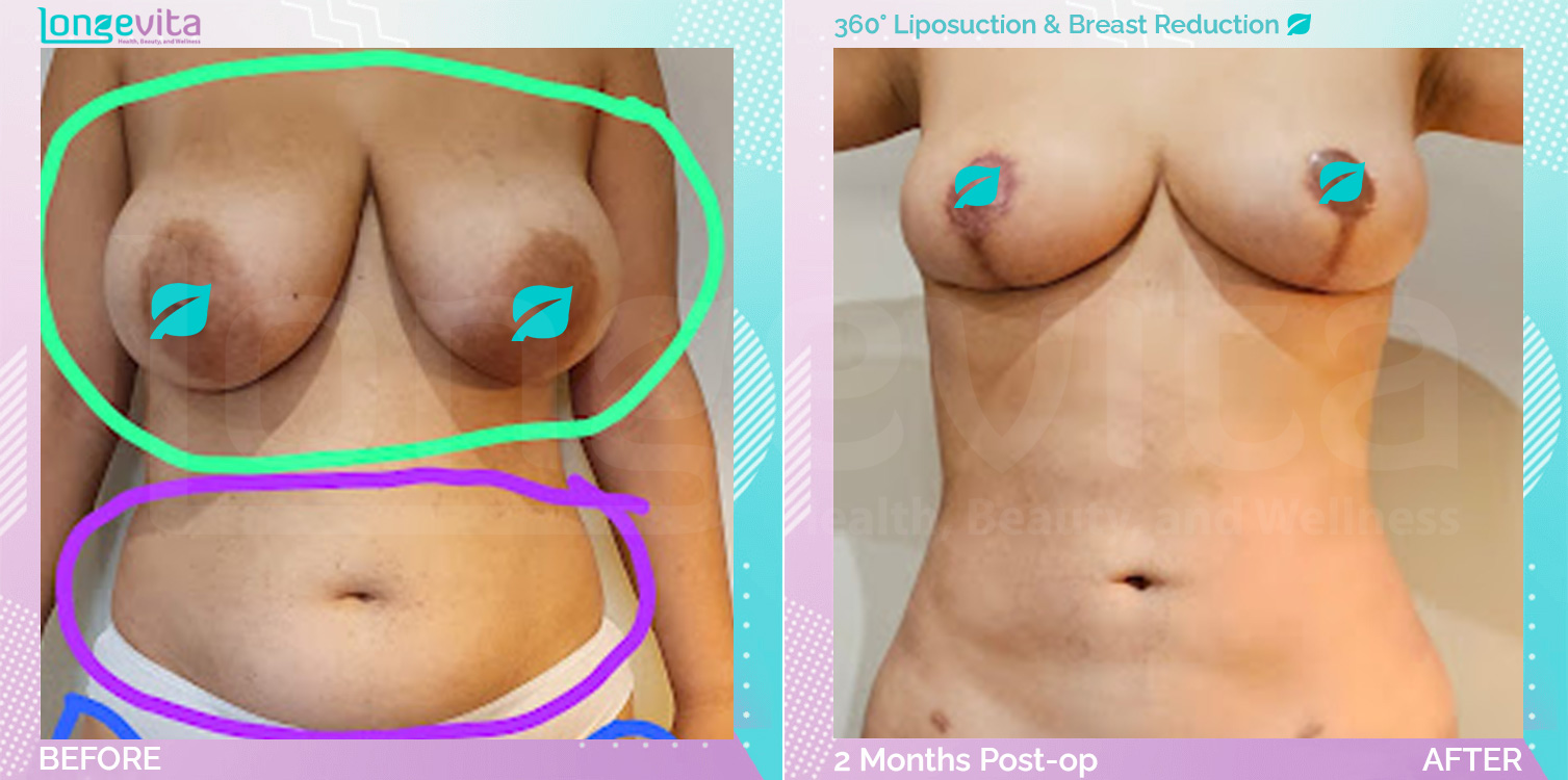 Breast Reduction and Liposuction before and after, Body, 30s female patient