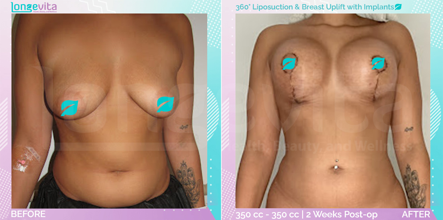 Breast Enlargement and Breast Lift and Liposuction before and after, Body, 20s female patient