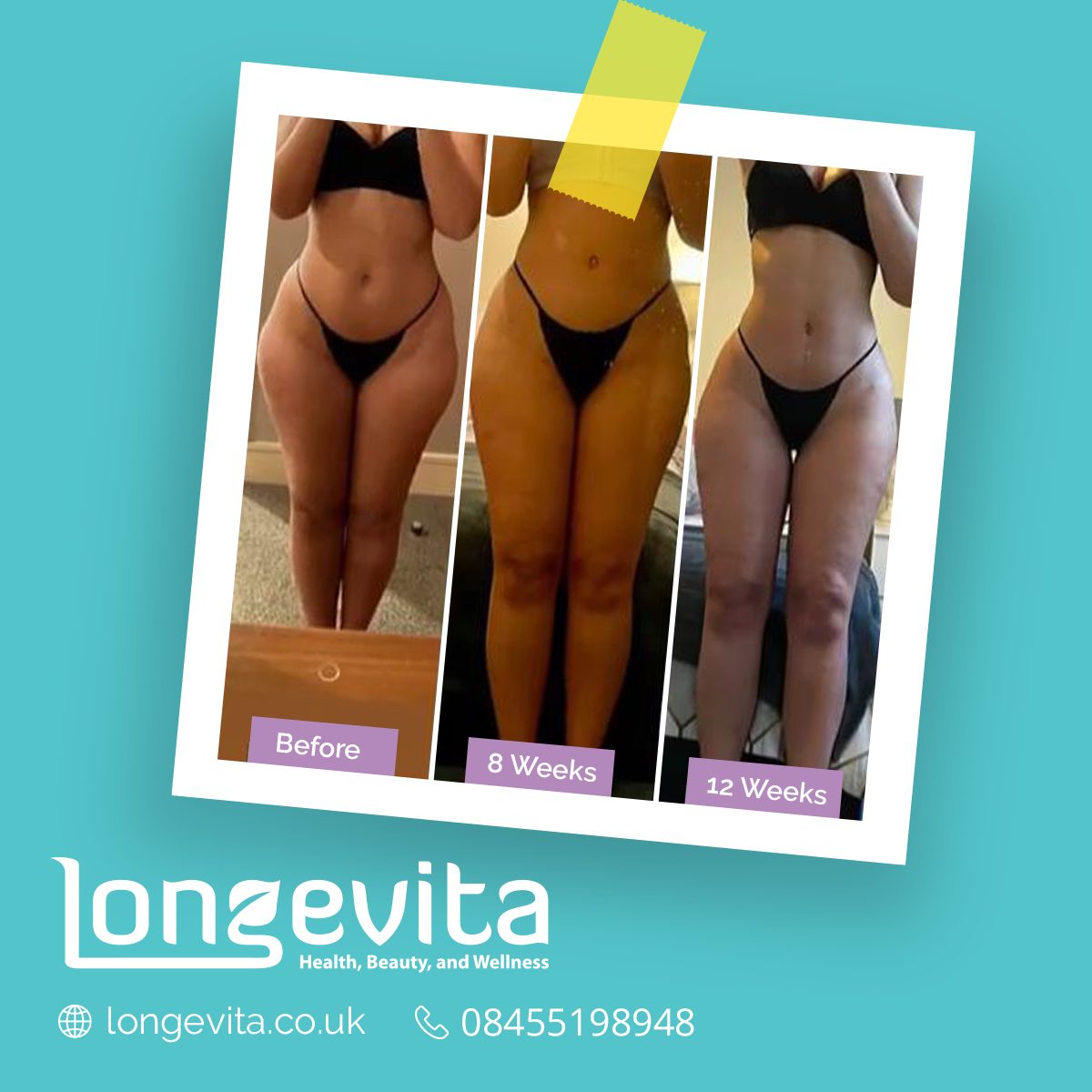 Liposuction before and after, Body, 20s female patient