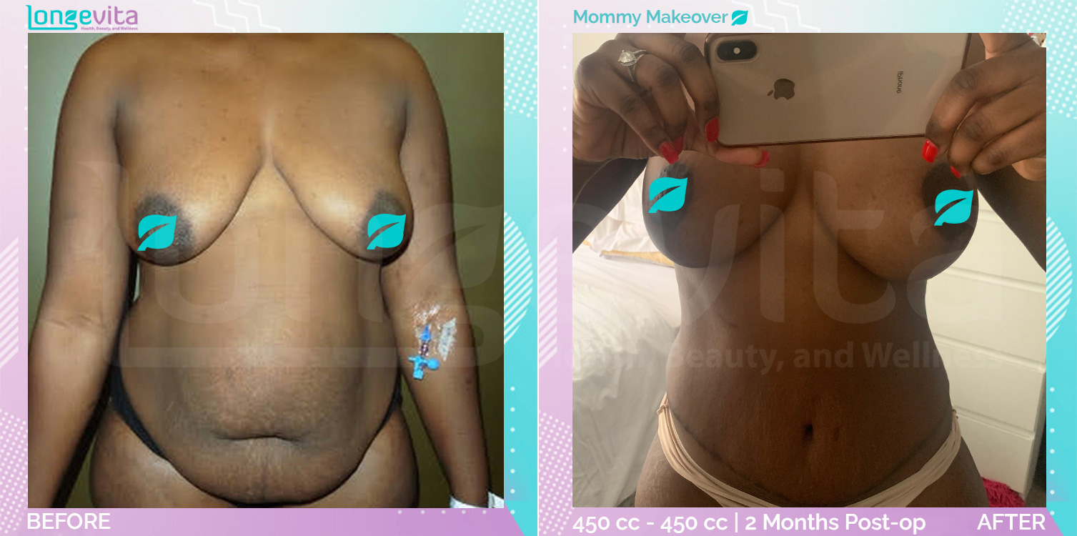 Breast Enlargement and Breast Lift and Liposuction and Tummy Tuck before and after, Body, 20s female patient
