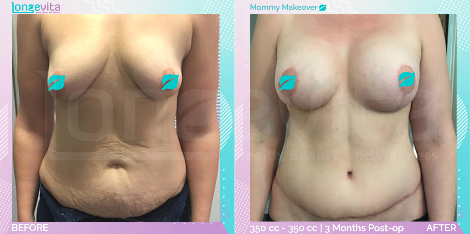 Breast Enlargement and Breast Lift and Liposuction and Tummy Tuck before and after, Body, 40s female patient