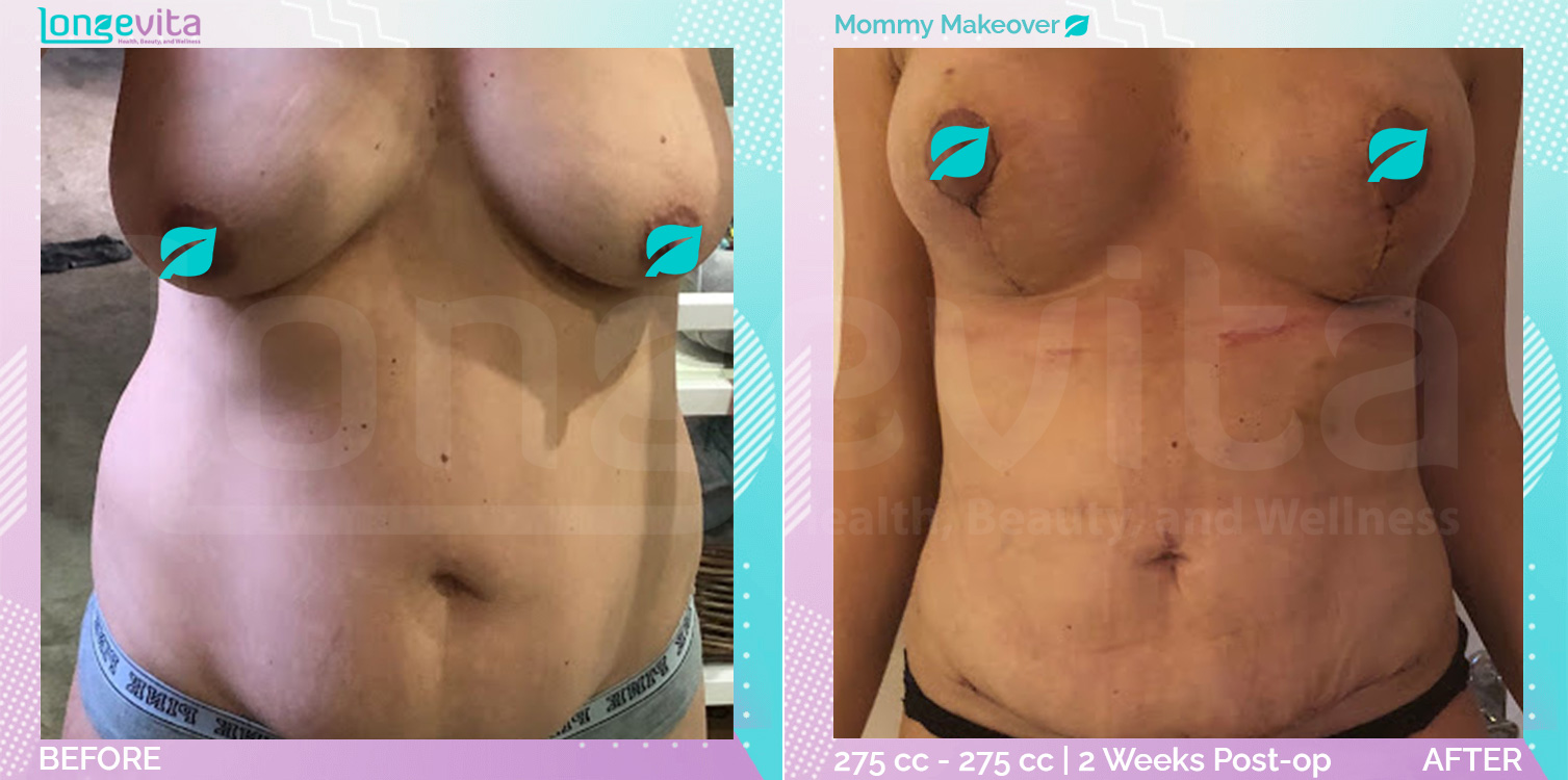 Breast Enlargement and Breast Lift and Liposuction and Tummy Tuck before and after, Body, 30s female patient