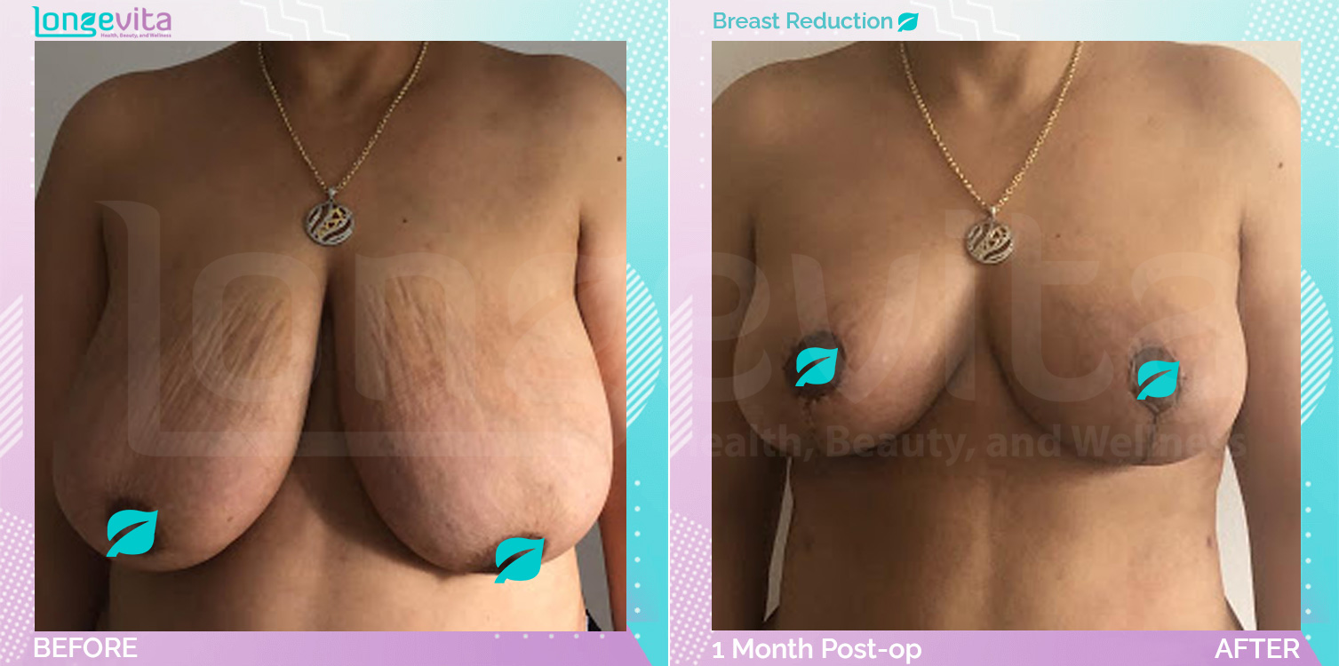 Breast Reduction and Liposuction and Tummy Tuck before and after, Body