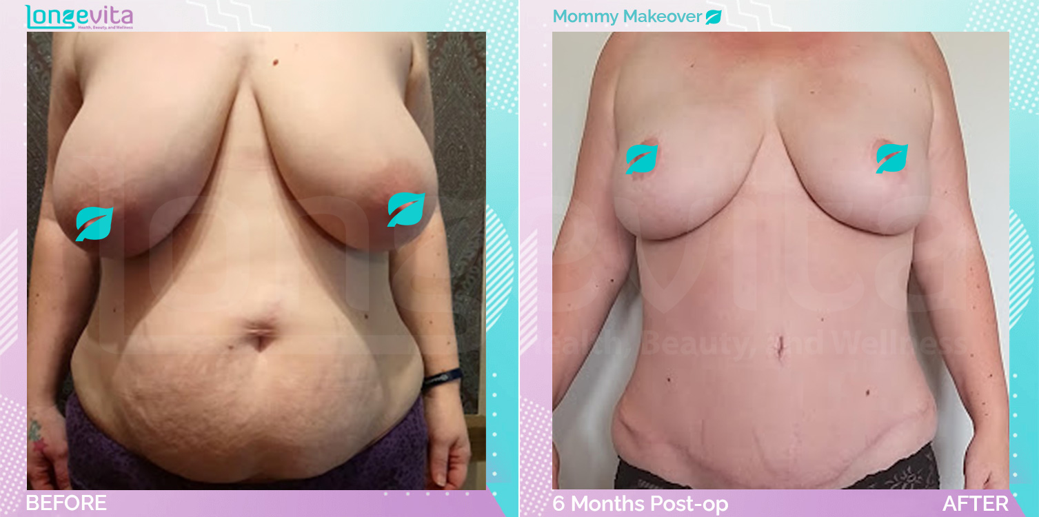 Breast Reduction and Liposuction and Tummy Tuck before and after, Body, 30s female patient