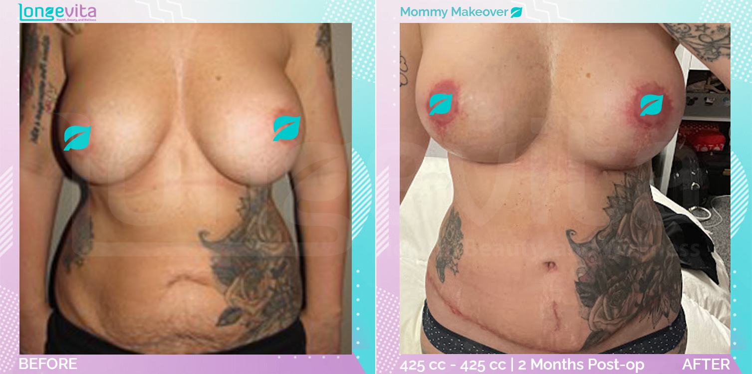 Breast Enlargement and Breast Lift and Liposuction and Tummy Tuck before and after, Body, 40s female patient