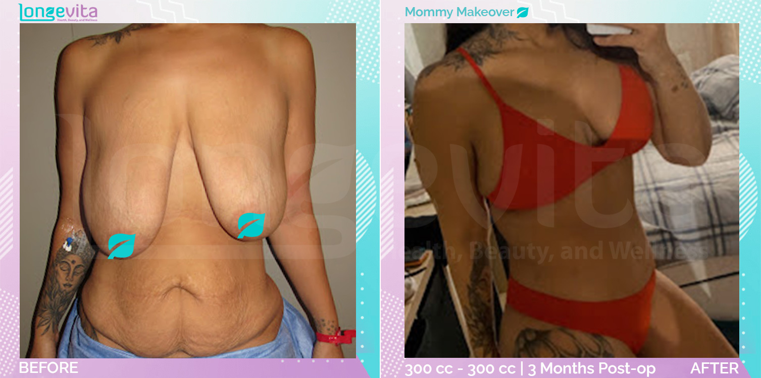 Breast Enlargement and Breast Lift and Liposuction and Tummy Tuck before and after, Body, 30s female patient