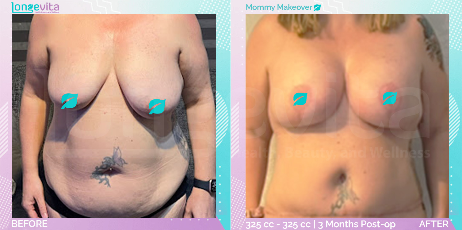 Breast Enlargement and Breast Lift and Liposuction and Tummy Tuck before and after, Body