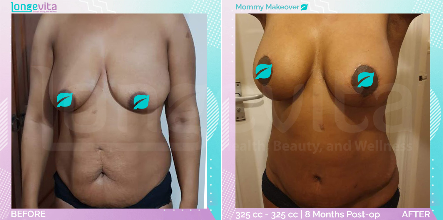 Breast Enlargement and Breast Lift and Liposuction and Tummy Tuck before and after, Body, 40s female patient