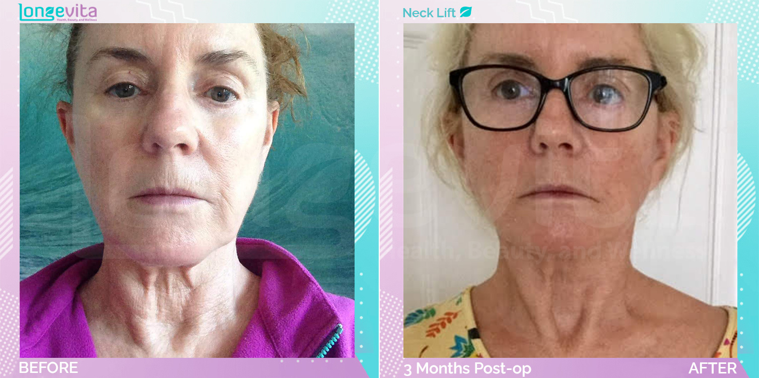Neck Lift before and after, Face, 60s female patient