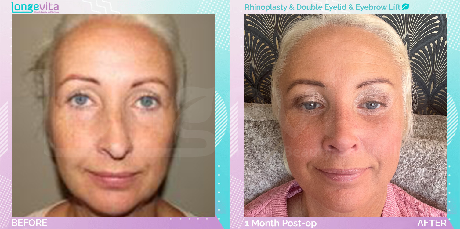 Eyebow Lift and Eyelid and Rhinoplasty before and after, Face, 40s female patient
