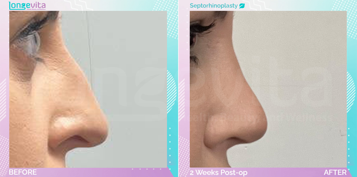 Septorhinoplasty before and after, Face, 20s female patient