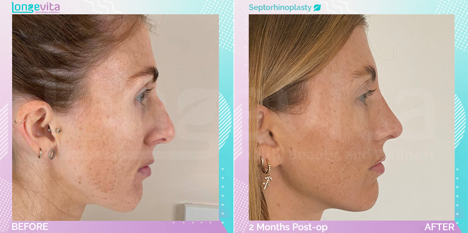 Septorhinoplasty before and after, Face, 20s female patient