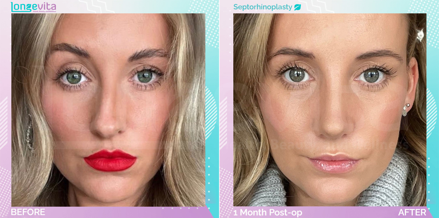 Septorhinoplasty before and after, Face, 20s female patient
