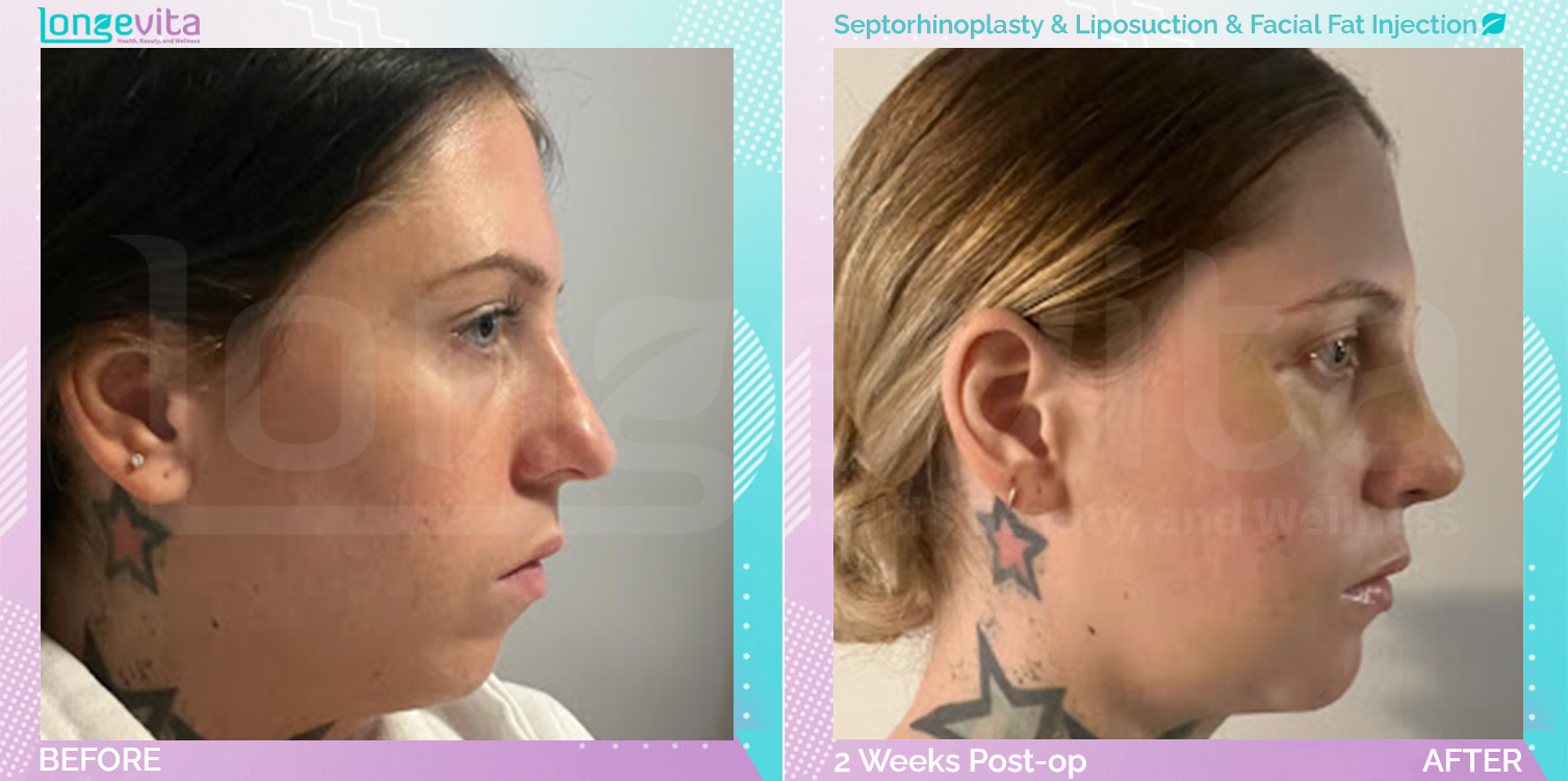 Facial Fat Injection and Liposuction and Septorhinoplasty before and after, Face, 20s female patient