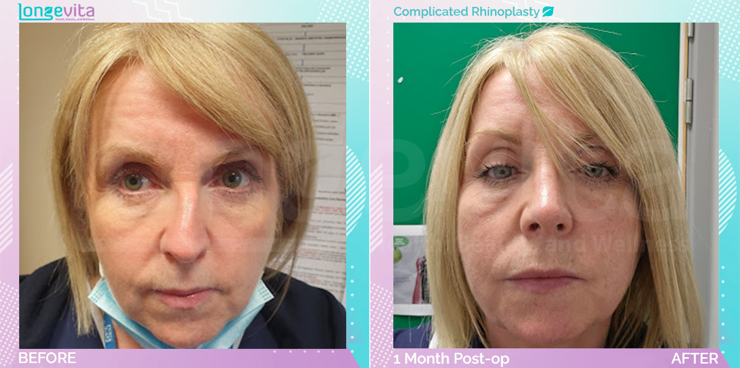 Complicated Rhinoplasty before and after, Face, 50s female patient