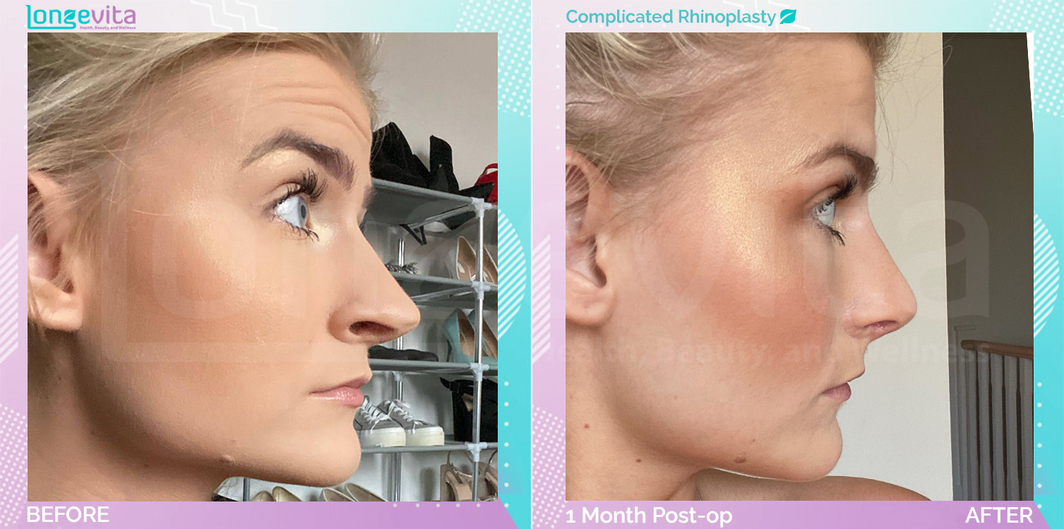 Complicated Rhinoplasty before and after, Face, 20s female patient