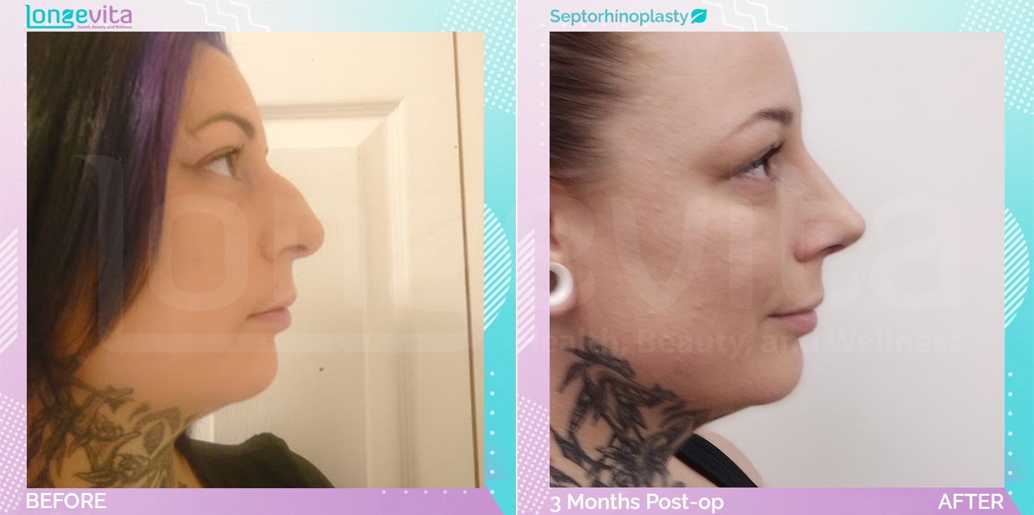 Septorhinoplasty before and after, Face, 30s female patient