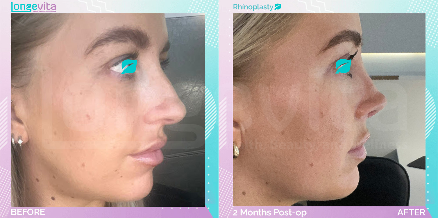 Rhinoplasty before and after, Face, 30s female patient
