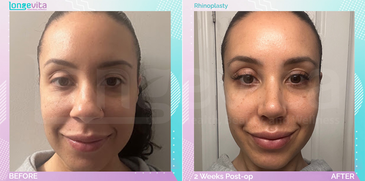 Rhinoplasty before and after, Face, 30s female patient