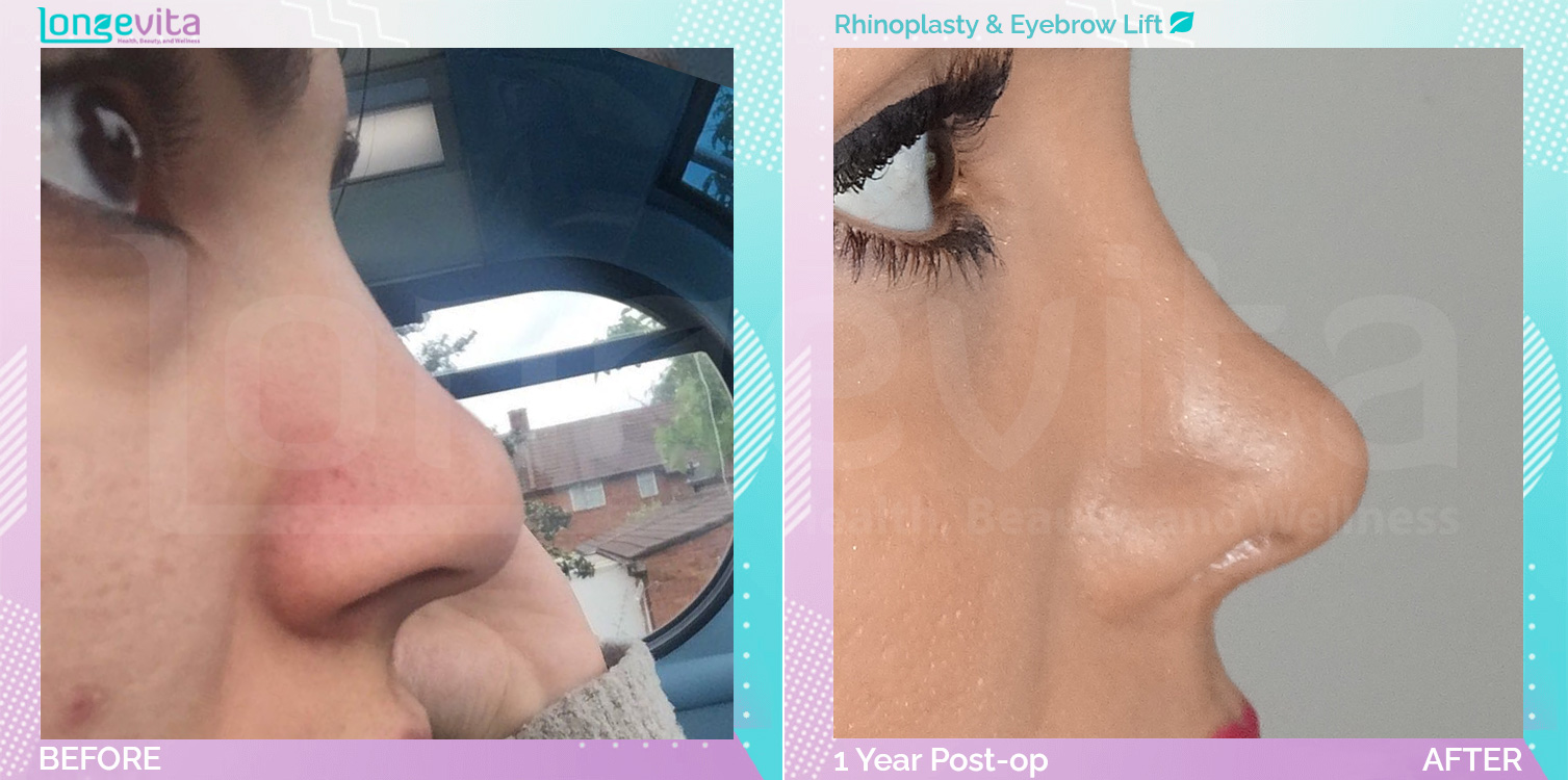 Eyebow Lift and Rhinoplasty before and after, Face, 20s female patient