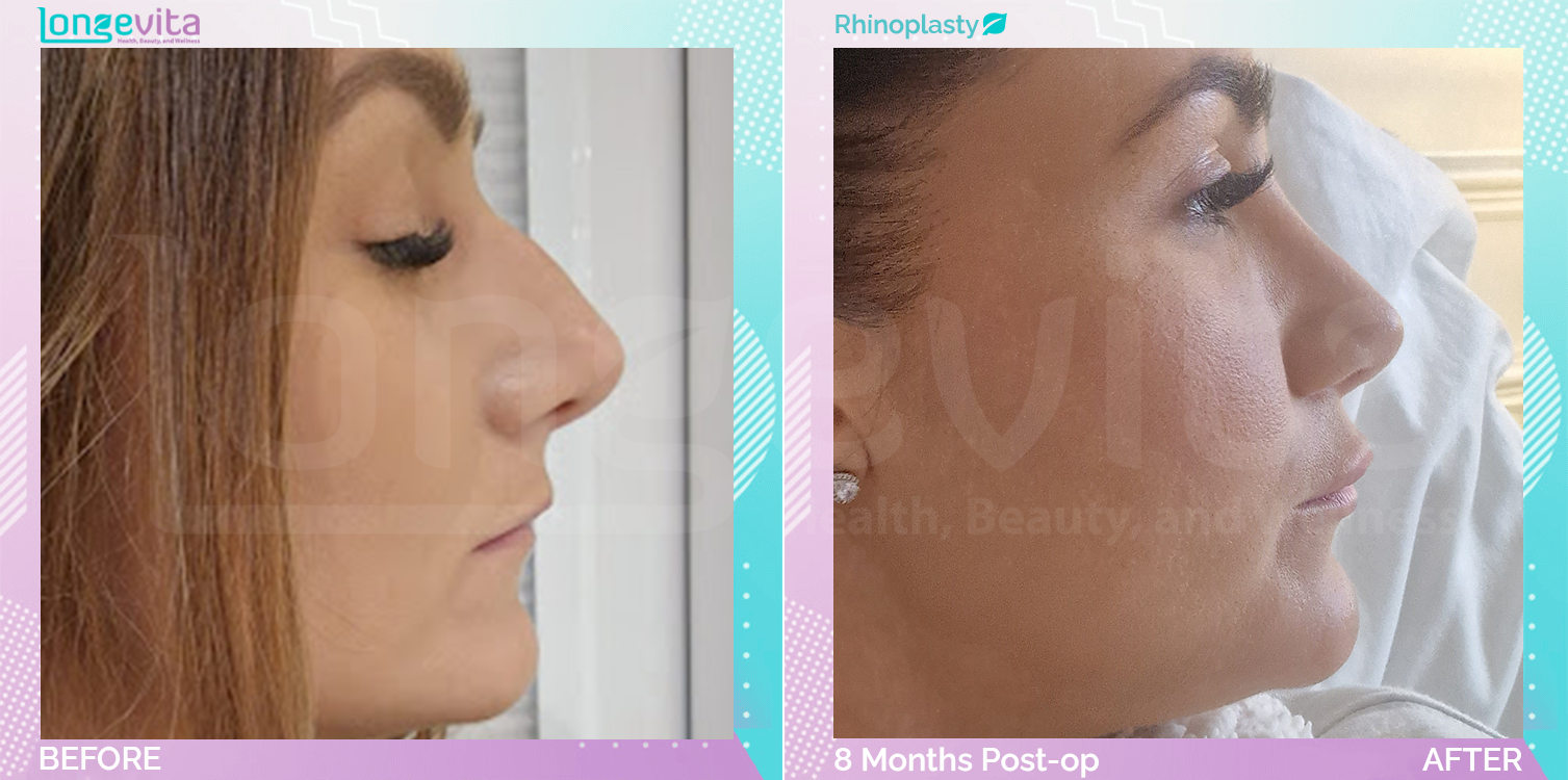 Rhinoplasty before and after, Face, 30s female patient