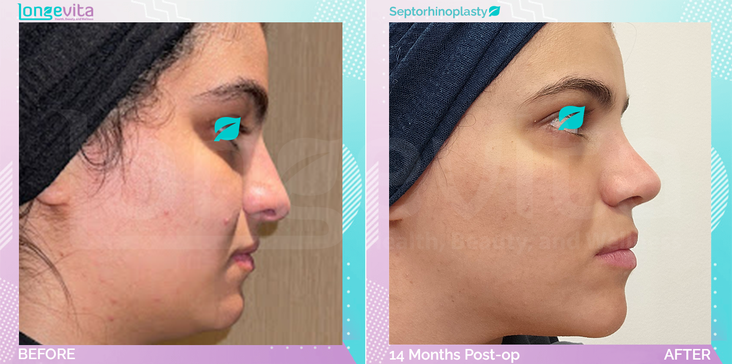 Septorhinoplasty before and after, Face, 20s female patient
