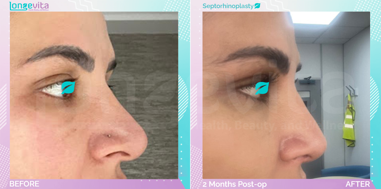 Septorhinoplasty before and after, Face, 40s female patient