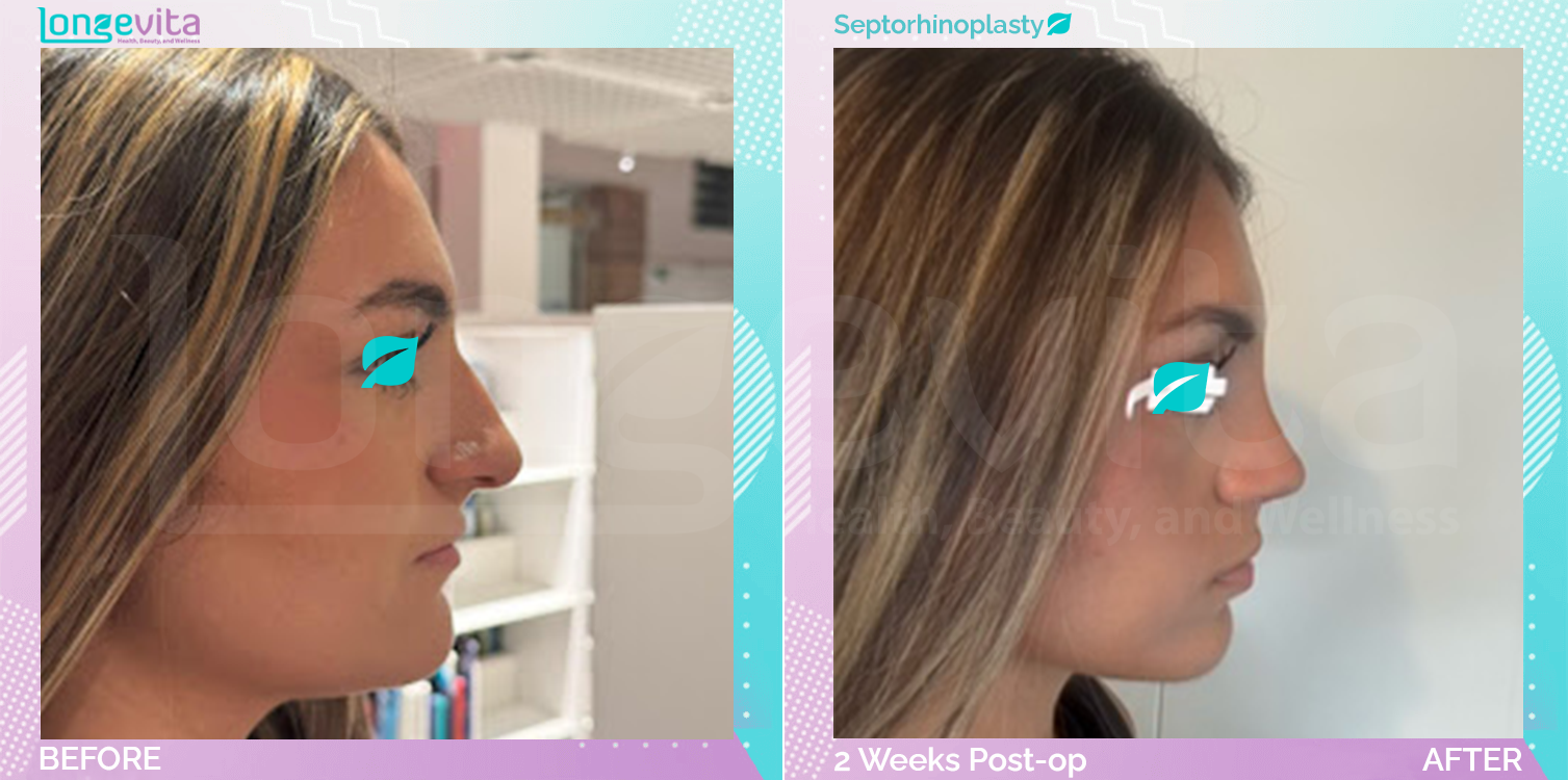 Septorhinoplasty before and after, Face