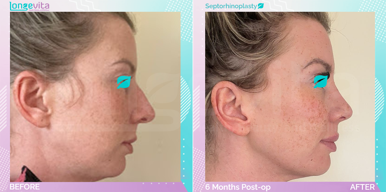 Septorhinoplasty before and after, Face, 30s female patient