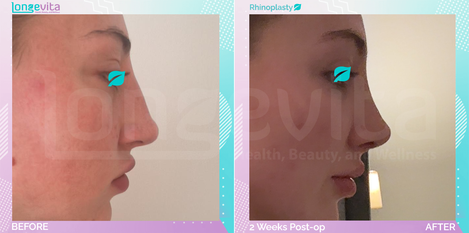 Rhinoplasty before and after, Face, 20s female patient