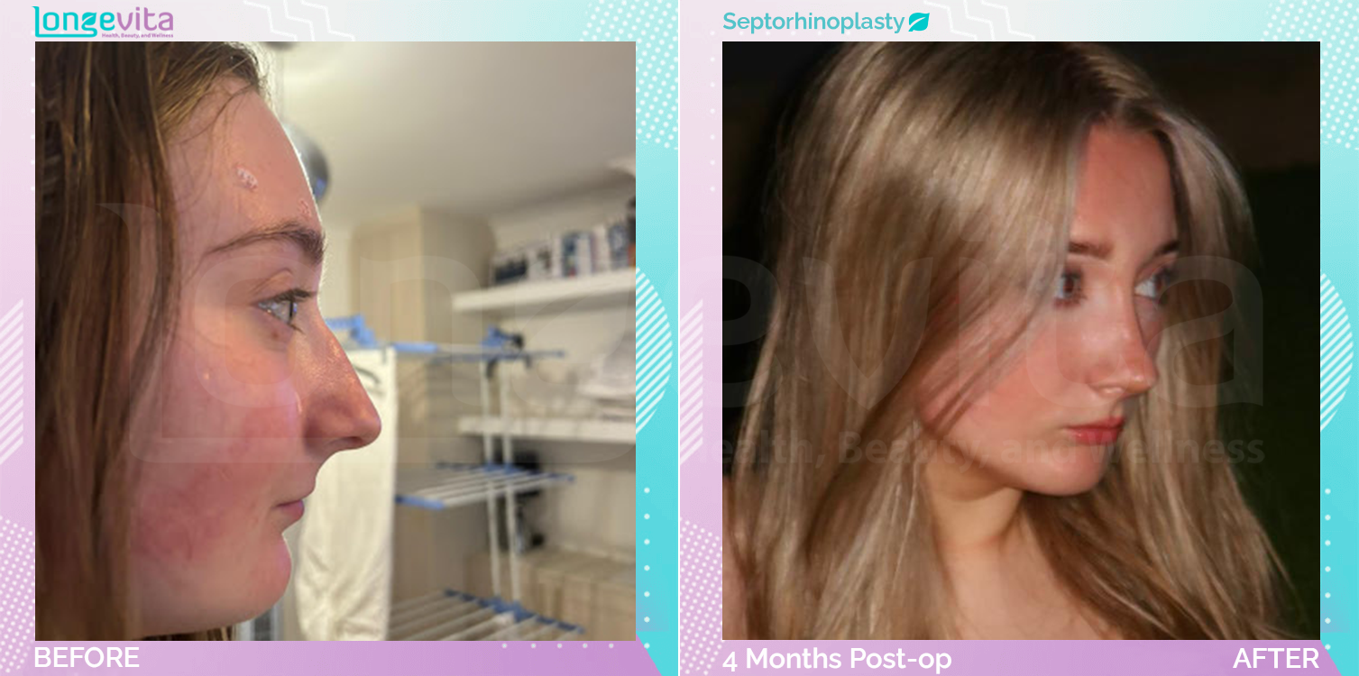 Septorhinoplasty before and after, Face