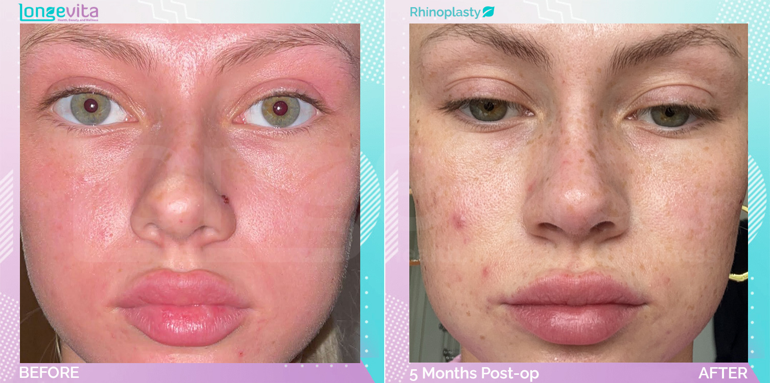 Rhinoplasty before and after, Face, 20s female patient