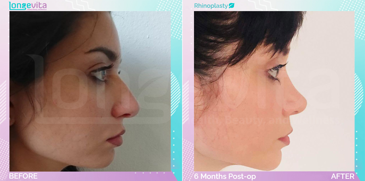 Rhinoplasty before and after, Face