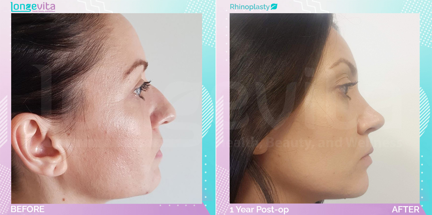 Rhinoplasty before and after, Face