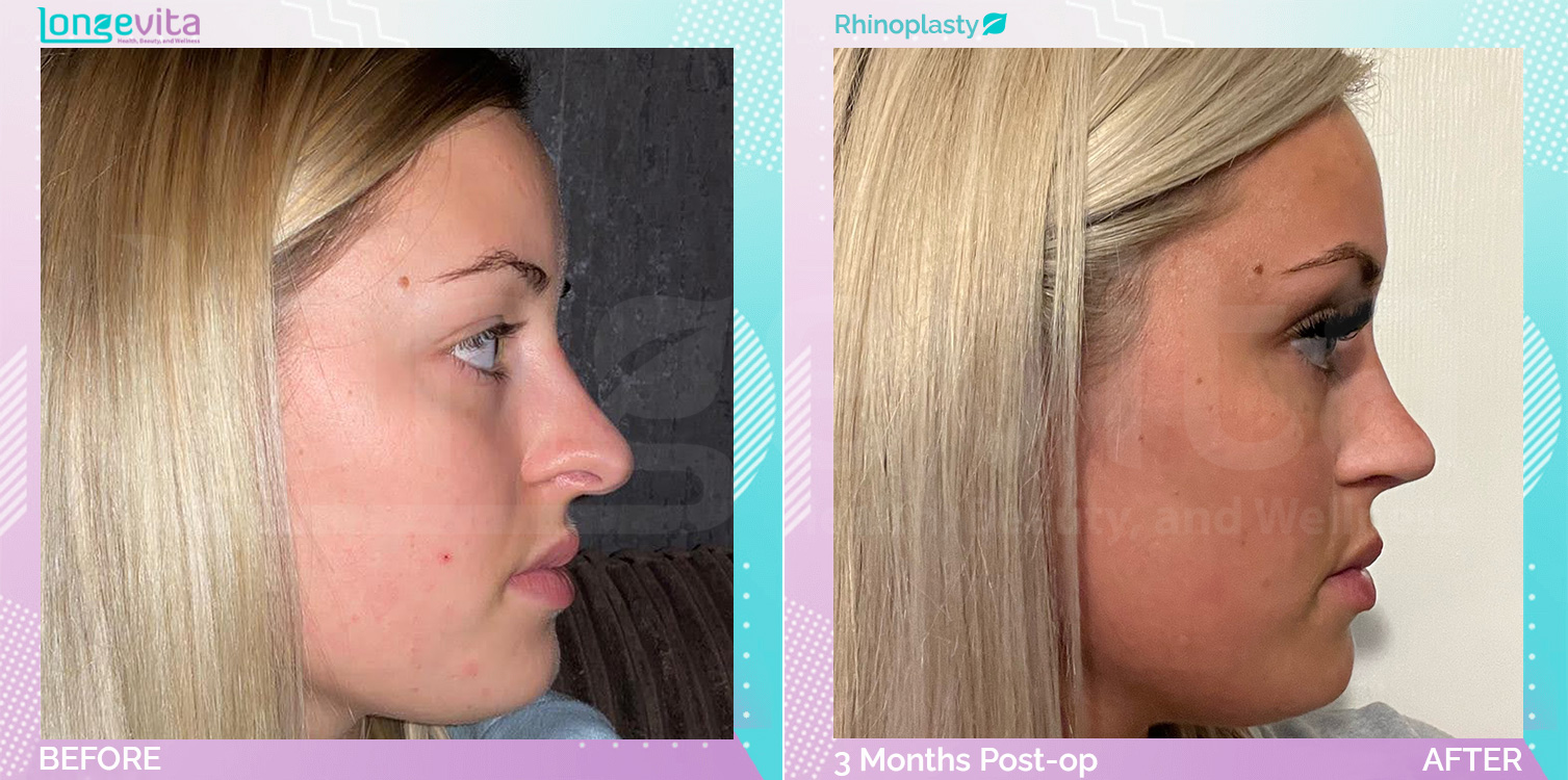 Rhinoplasty before and after, Face, 20s female patient