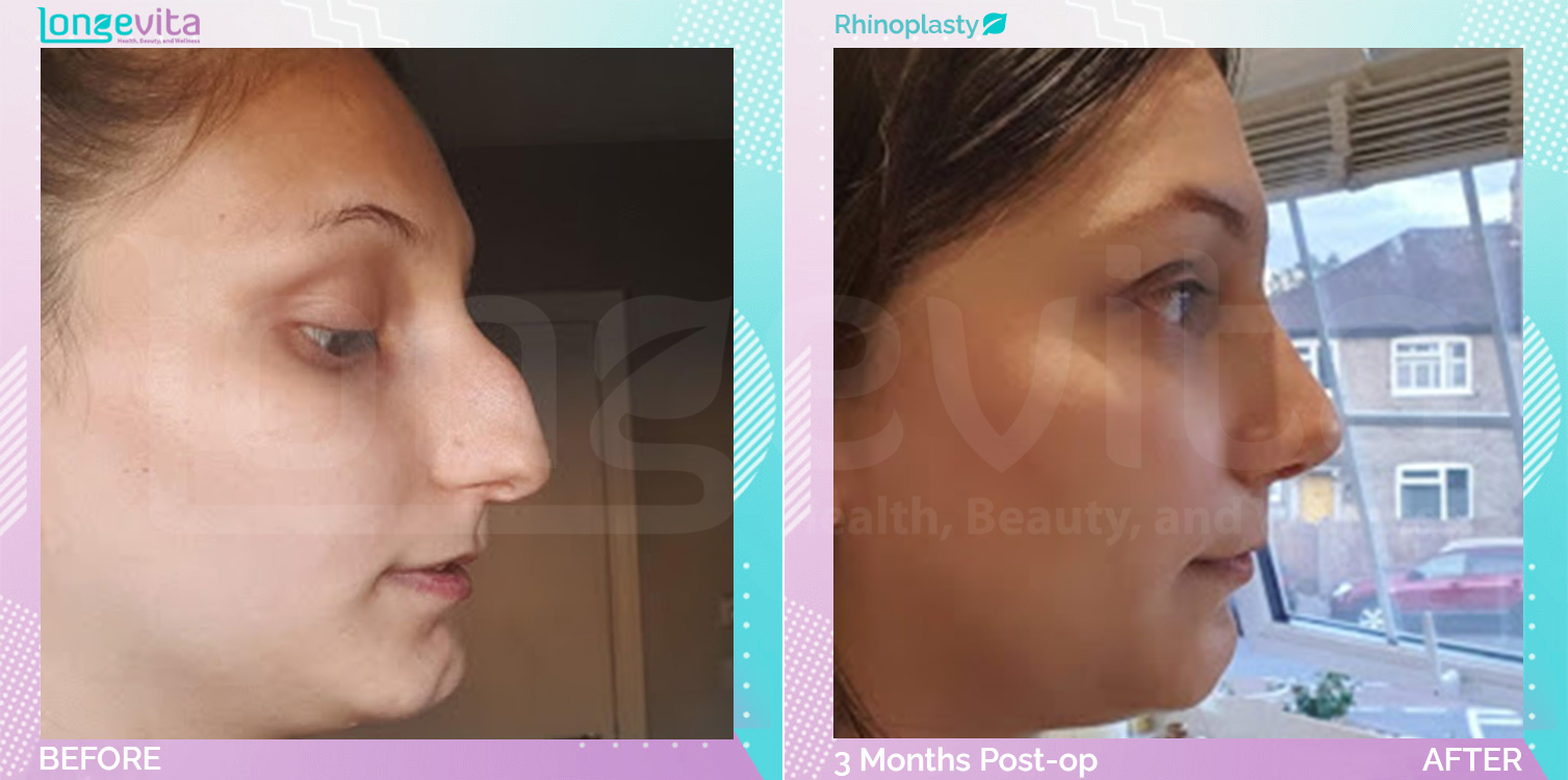 Rhinoplasty before and after, Face, 20s female patient