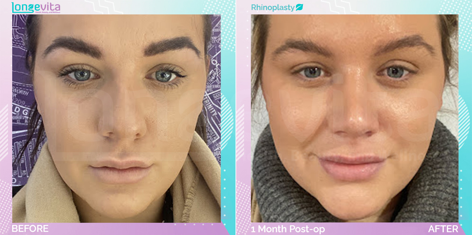 Rhinoplasty before and after, Face, 20s female patient
