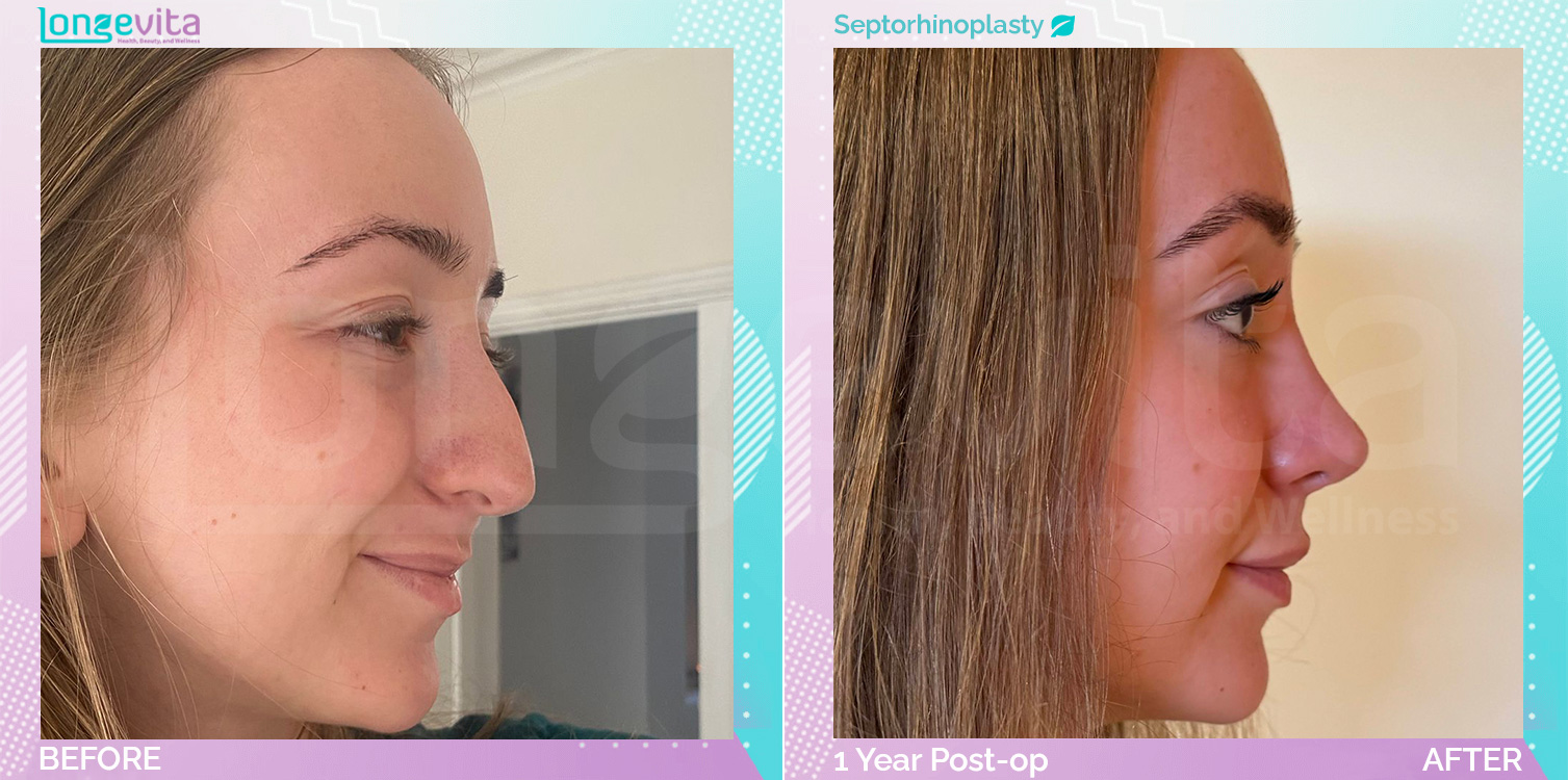 Septorhinoplasty before and after, Face, 20s female patient