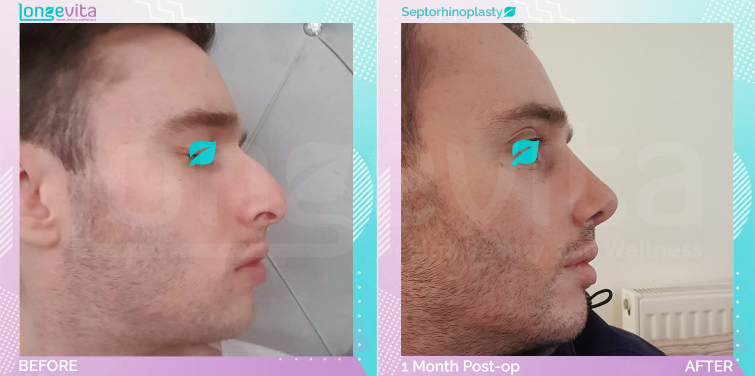 Septorhinoplasty before and after, Face, 30s male patient